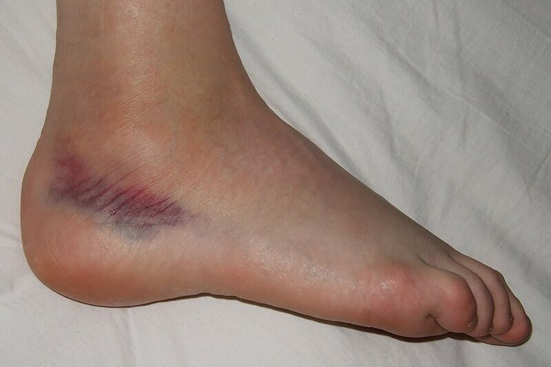     Почему у нас появляются синяки