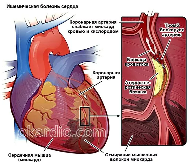 Больной с инфарктом миокарда