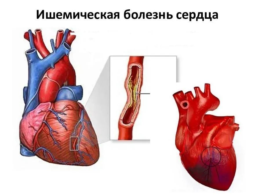 Поражения коронарных сосудов. ИБС стенокардия инфаркт миокарда. Коронарные сосуды сердца ИБС. Сердца анатомия ишемия.