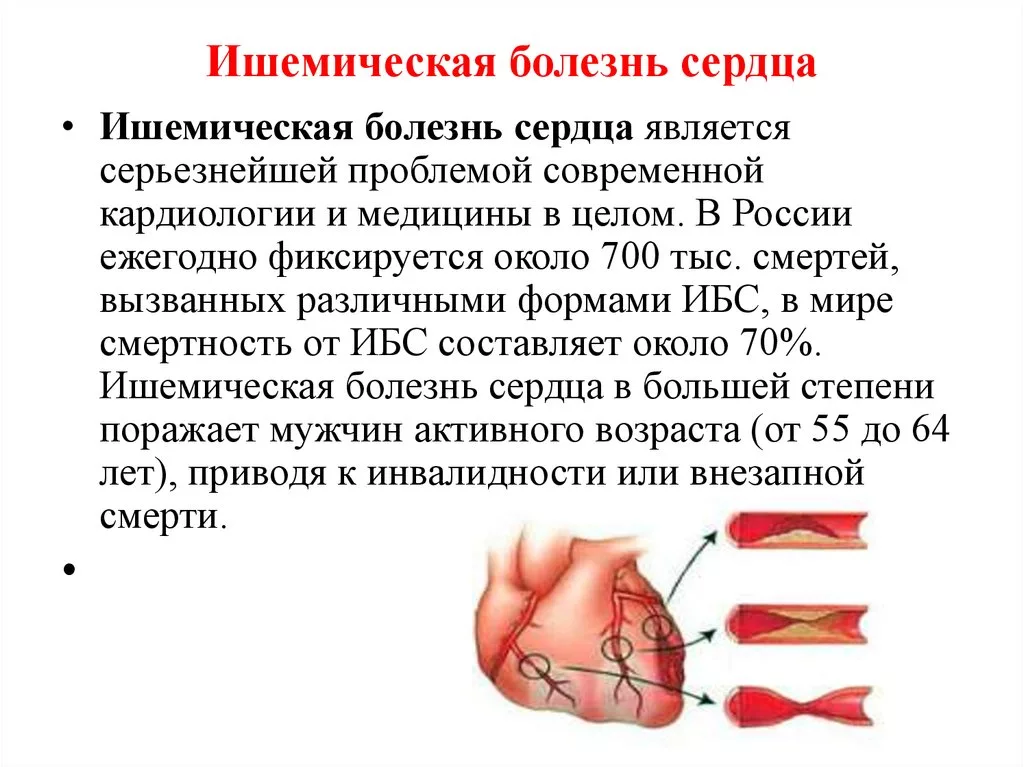 Чем опасна ишемия. Ишемическая болезнь сердца симптомы. Ишемышечная болезнь сердца. ИБС н2б.