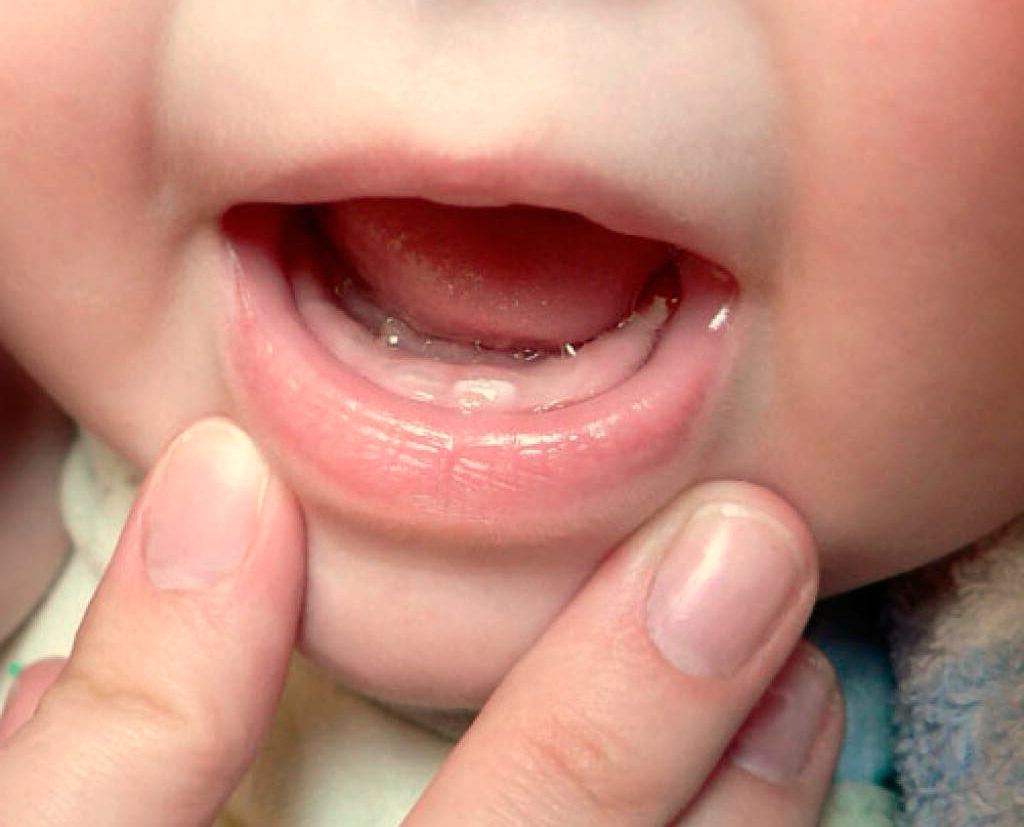 Прорезывание 8 зуба у детей