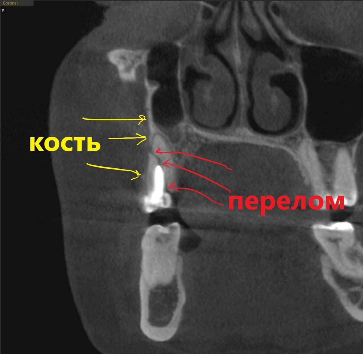 А что будет, если не удалять сломанный корень? Финансовые последствия в  цифрах | Parodoctor | Дзен