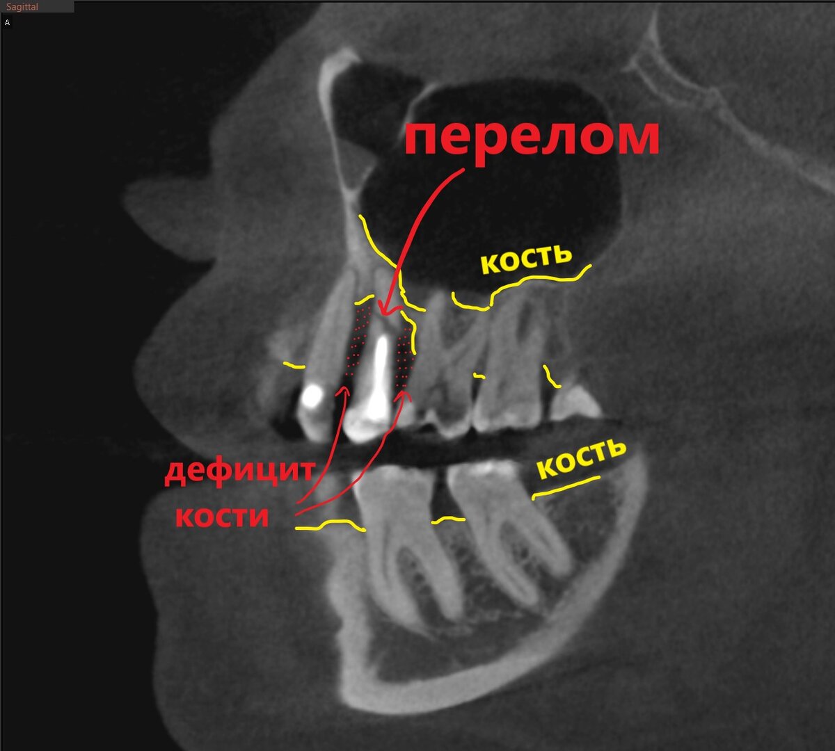 Перелом корня зуба 2.5, правая 5-ка, вид сбоку