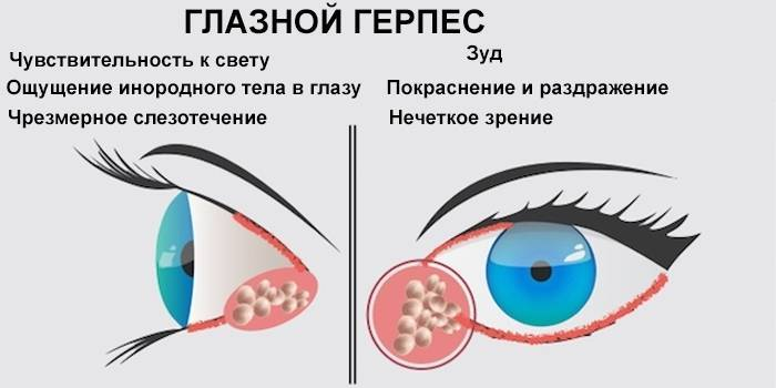 Быстрое лечение герпеса на губах