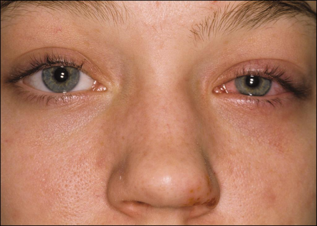 Текут глаза при простуде. Герпесный конъюнктивит конъюнктивит. Конъюнктивит герпетический кератит. Герпетический гепатти.