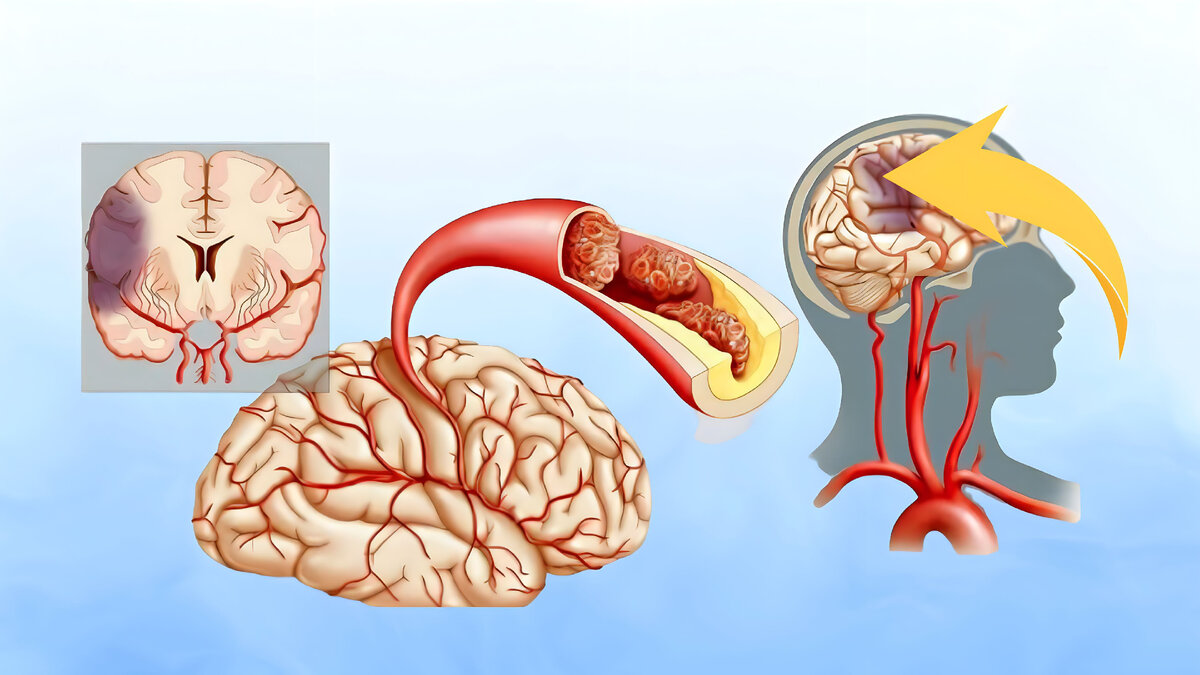 Ишемический инсульт препарат