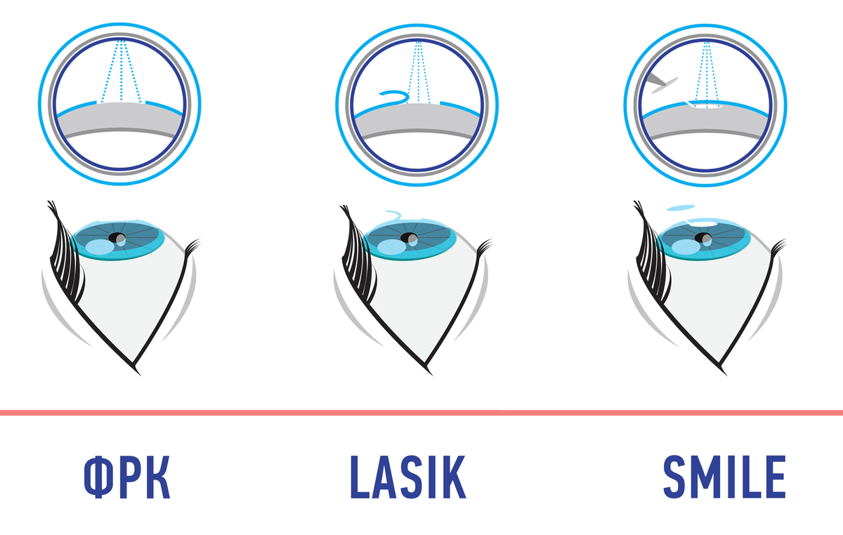 Коррекция зрения методом смайл. ФРК ласик. Коррекция зрения по технологии ФРК (фоторефракционная кератэктомия). Лазерная коррекция зрения схема. Коррекция зрения методом ФРК.