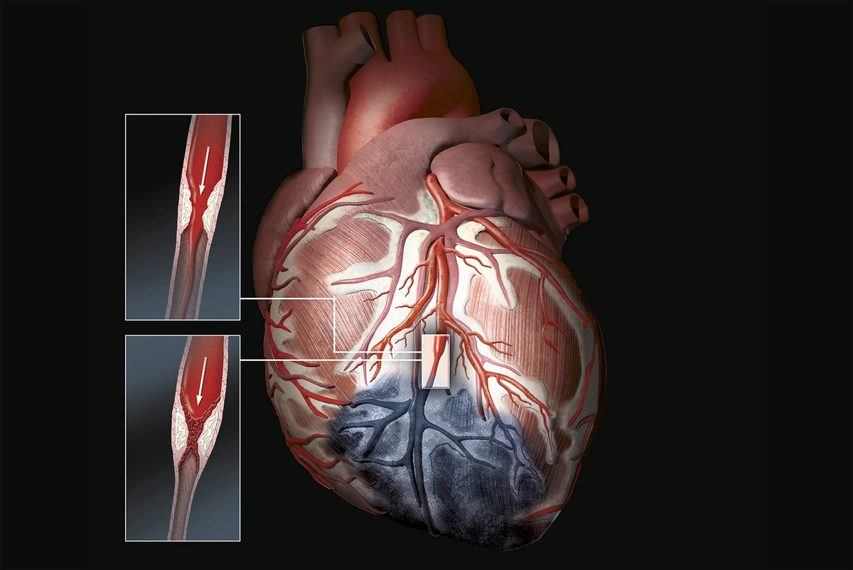 Инфаркт миокарда – как он проявится, почему возникает и что делать? Ответы  врача | О здоровье: с медицинского на русский | Дзен