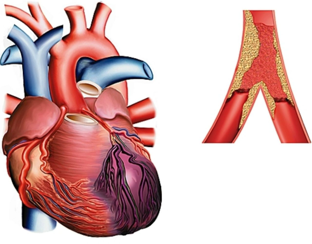 Сердце инфаркт миокарда. Инфаркт миокарда ишемическая болезнь. Ишемия инфаркт миокарда. Бляшка инфаркт миокарда.