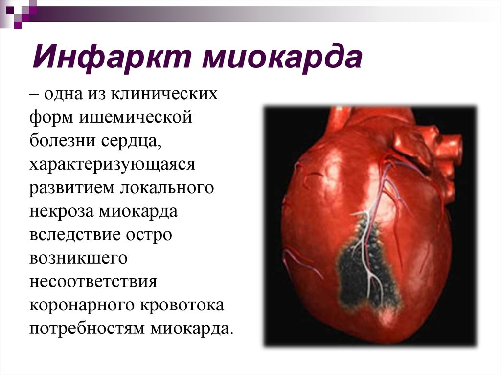 Инфаркт миокарда (сердечный приступ): причины, симптомы и лечение в статье аритм