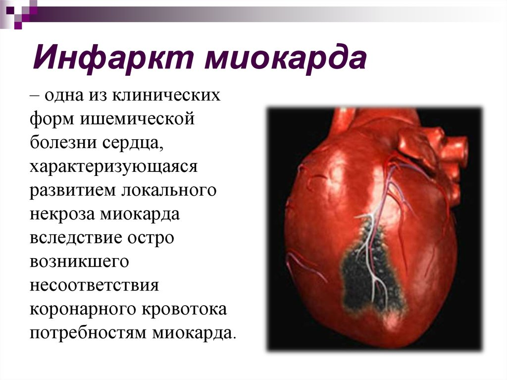 Жизнь без инфаркта. Инфаркт мил.