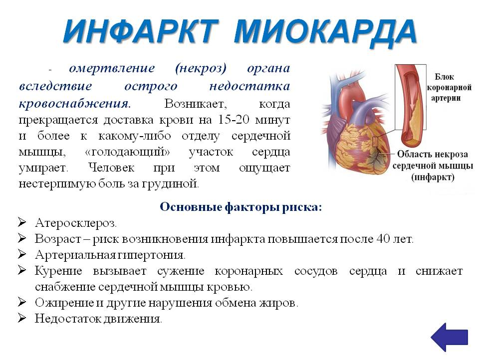 Инфаркт Мио Арда.