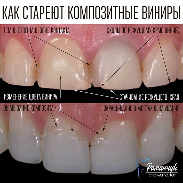 Установка виниров на депульпированные зубы