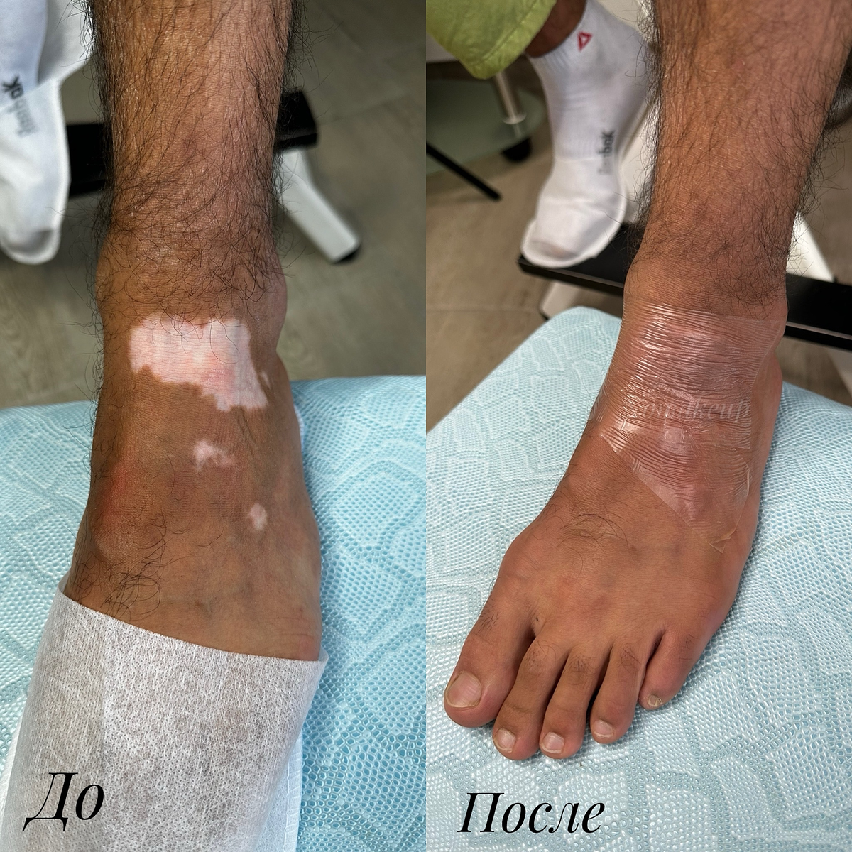 Когда у клиента смуглый натуральный цвет кожи - изменения в пигментации кожи особенно заметны и контрастны. 