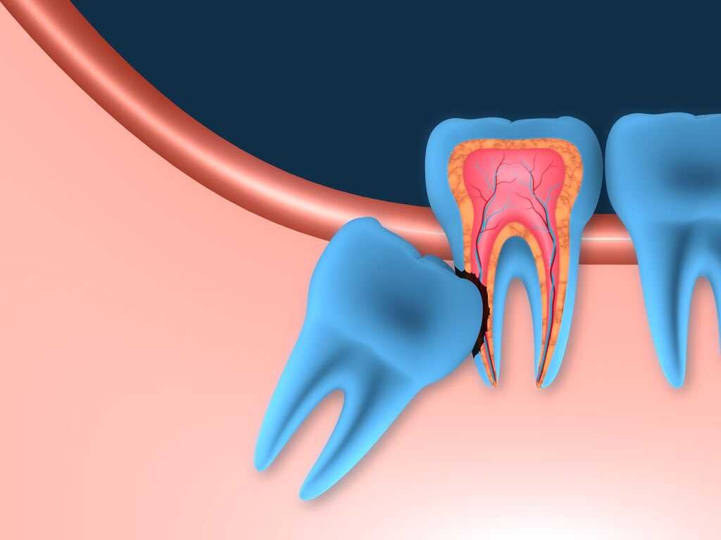 Кривые зубы у детей и взрослых