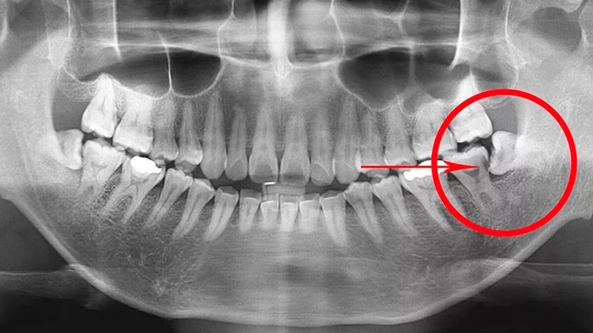 Лезет зуб мудрости: что делать?