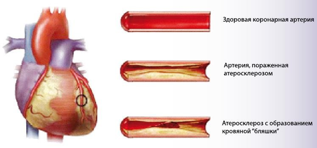 Стадии атеросклероза 