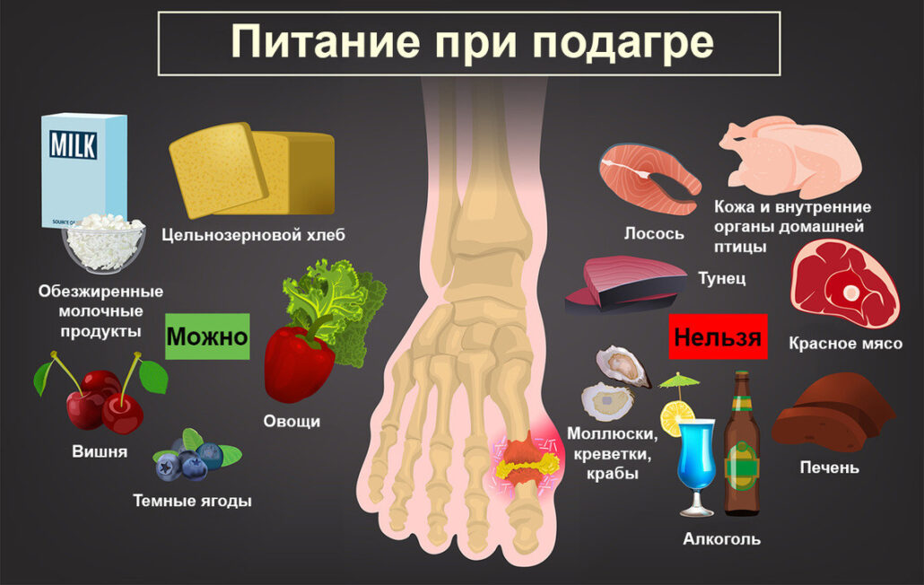 Подагра какую рыбу есть. Еда при подагре. Факторы риска при подагре. Подагра питание при подагре.