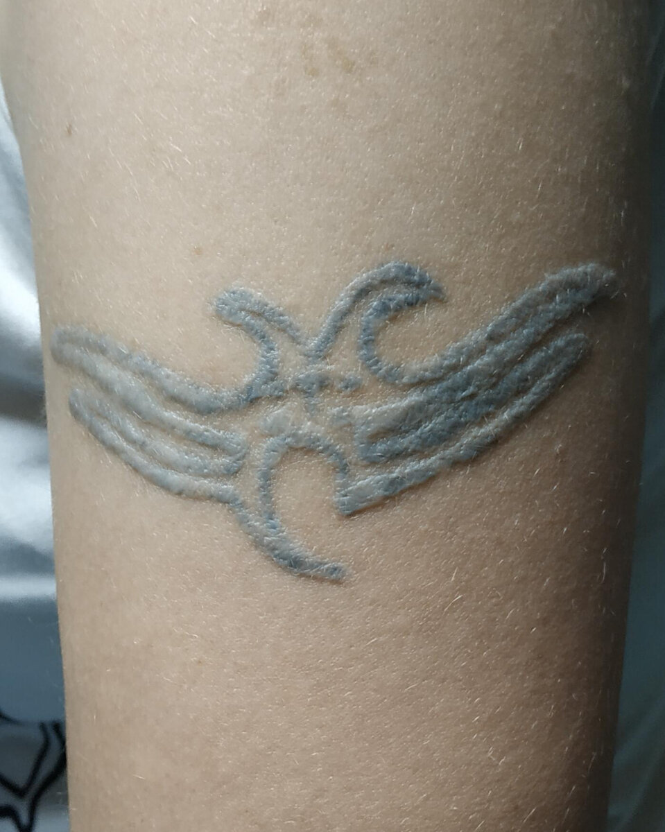 Можно ли удалить татуировку полностью без шрамов? | longway tattoo ...