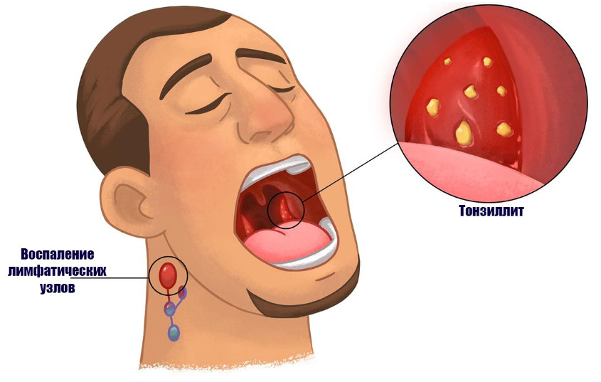Ангина или острый тонзиллит – почему без антибиотиков при ней не обойтись? Рассказала врач