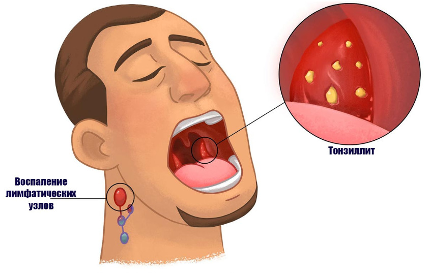 Хронический тонзиллит: диагностика и правильное лечение | ЛОР КЛИНИКА ЗАЙЦЕВА | Дзен