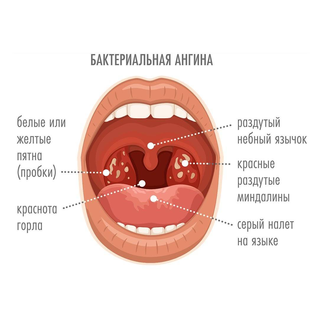 При тонзиллите какие