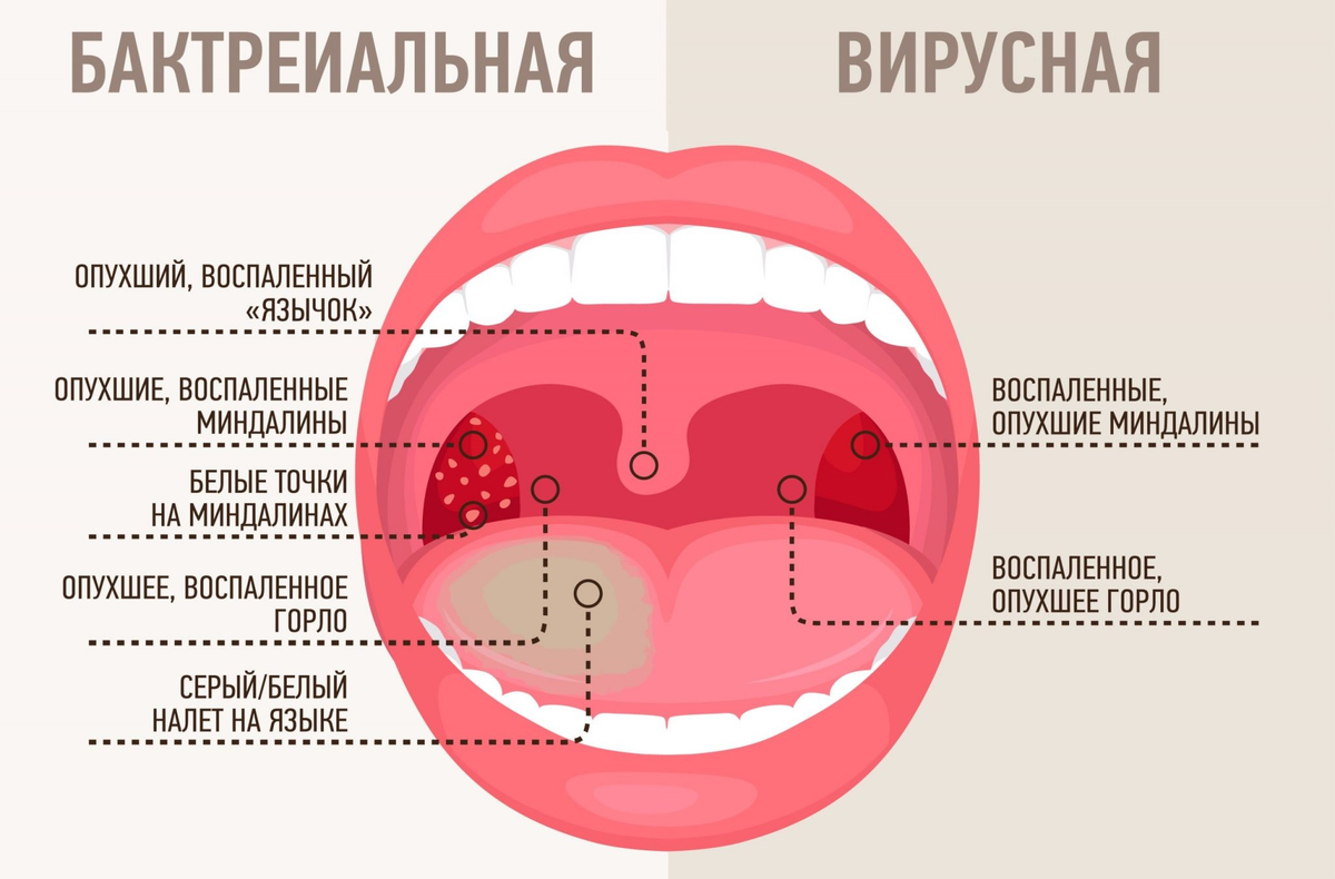 Тонзиллит - причины появления, симптомы заболевания, диагностика и способы лечен