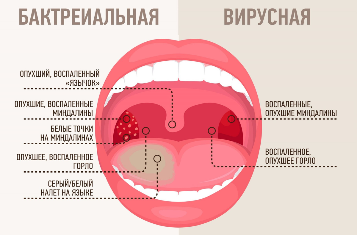 Ангина у детей температура сколько. Горло при вирусной инфекции. Бактериальная ангина на миндалинах.