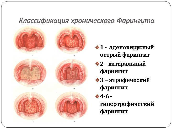 Кандидозный тонзиллит фото горла лечение у взрослых Ангина или острый тонзиллит - почему без антибиотиков при ней не обойтись? Расск