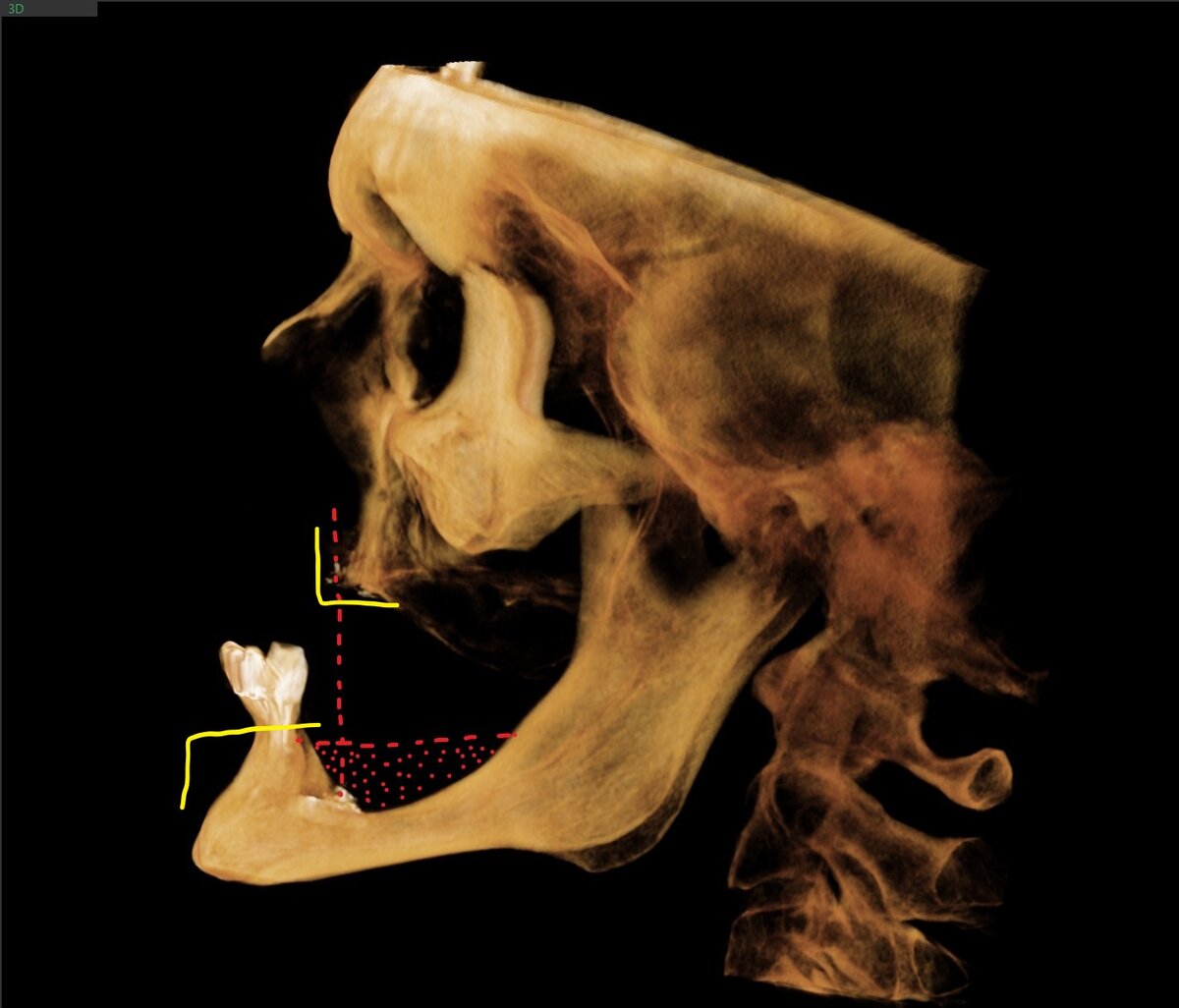 Ношение съёмных протезов более 20 лет  