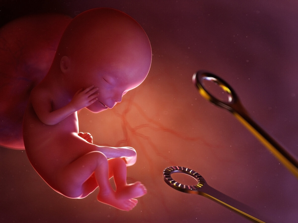 Расчленить, выскоблить или отравить? 