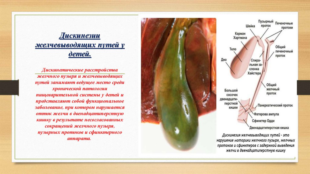 Сократимость желчного. Клиническая картина дискинезии желчевыводящих путей. Памятка дискинезия желчевыводящих путей. Дискинезия жёлчного пузыря и желчевыводящих путей. Дискинезия желчного пузыря и желчных путей..