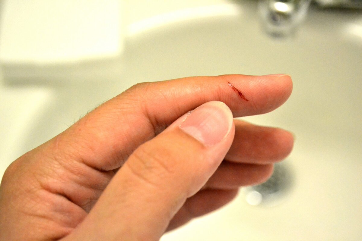 Почему от холода трескается кожа на руках – причины трещин на пальцах от мороза зимой