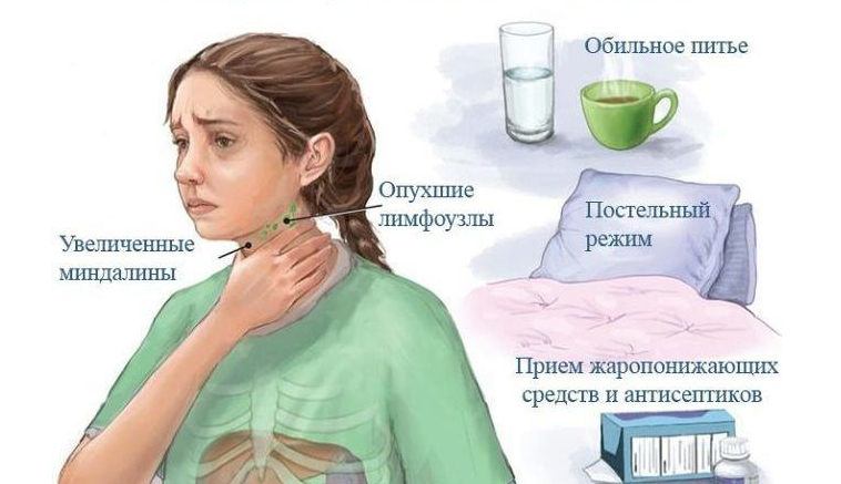 Горло от кондиционера. Инфекционный мононуклеоз вирус Эпштейна Барра. Мононуклеозная ангина. Инфекционный мононуклеоз лимфоузлы.