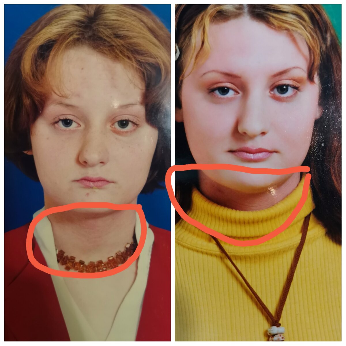 Здесь мне 11 и 16 лет. Видны расчесы на шее.