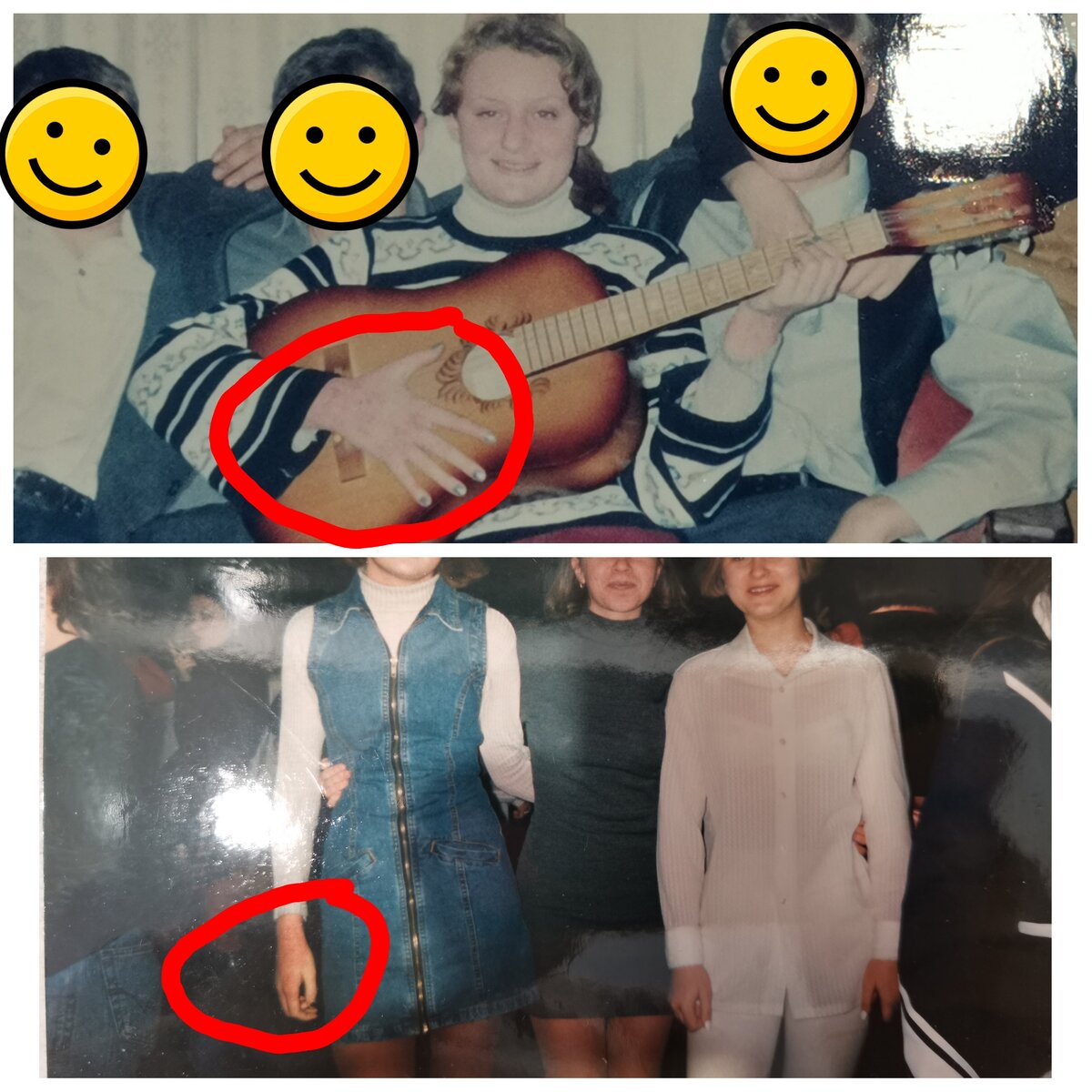 Я носила обычно водолазки, стеснялась, но всегда у меня было много подруг, и я везде ходила. Видны расчесы на руках. 