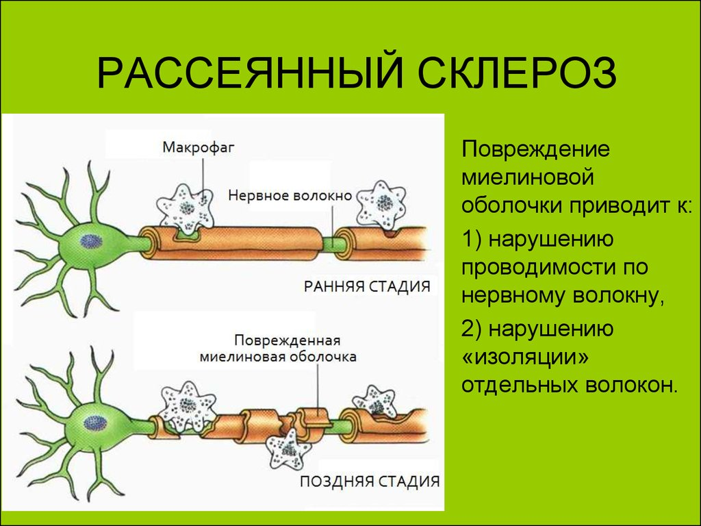 Склероз пример. Рассеянный склероз миелиновая оболочка. Поврежденные миелиновые оболочки нервных волокон. Миелиновая оболочка при рассеянном склерозе. Миелиновое нервное волокно рассеянный склероз.