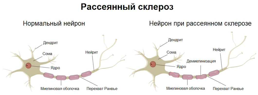 Рассеянный склероз 2 типа. Рассеянный склероз нервная клетка. Патогенез рассеянного склероза схема. Клиническая картина рассеянного склероза неврология. Рассеянный склероз миелиновая оболочка.