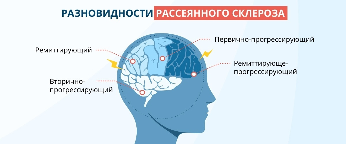 Излечение рассеянного склероза. Рассеянный склероз. Симптомы рассеянного склероза. Рассеянный склероз рассеянный склероз. Рассеянный склероз картинки.