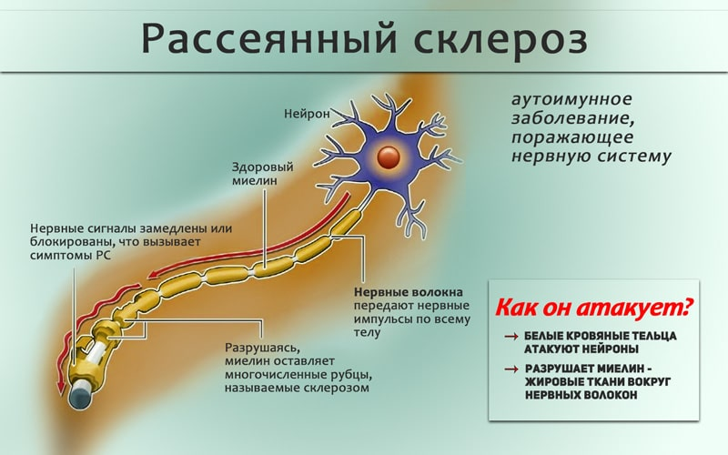 Рассеянный склероз побочные эффекты. Рассеянный склероз миелиновая оболочка. Поврежденные миелиновые оболочки нервных волокон. Рассеянный склероз аутоиммунное заболевание. Миелин рассеянный склероз.