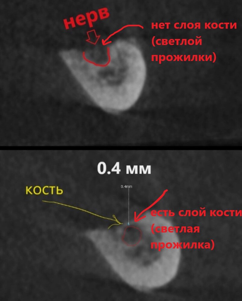 Кости нет, но вы держитесь - имплантация при значительной деструкции ...