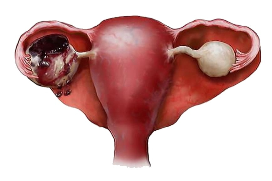 Внематочная эндометрий. Апоплексия кисты яичника. Апоплексия, разрыв яичников. Апоплексия капсулы яичника.