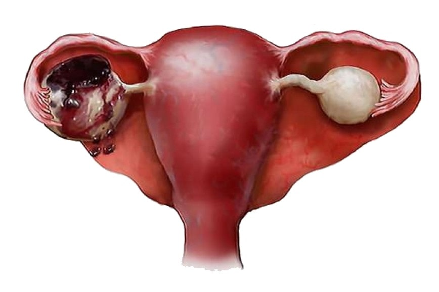 Почему болят яичники причины. Апоплексия кисты яичника. Апоплексия, разрыв яичников. Апоплексия капсулы яичника.
