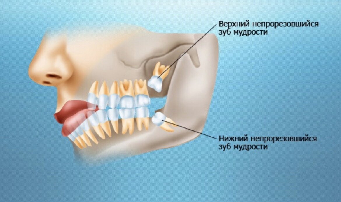 Как долго растут зубы мудрости