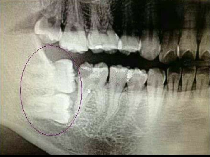 Ретинированный зуб рентген. Ретинированный зуб мудрости. Зуб 8 корень