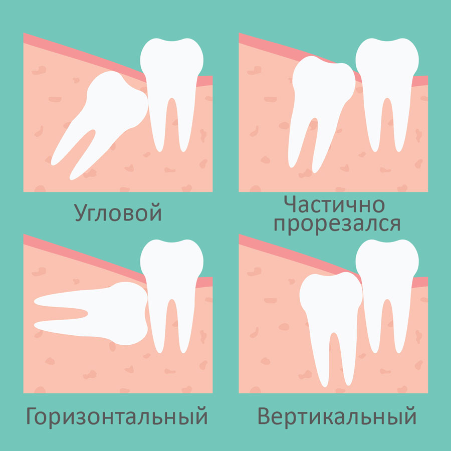 Как долго растут зубы мудрости