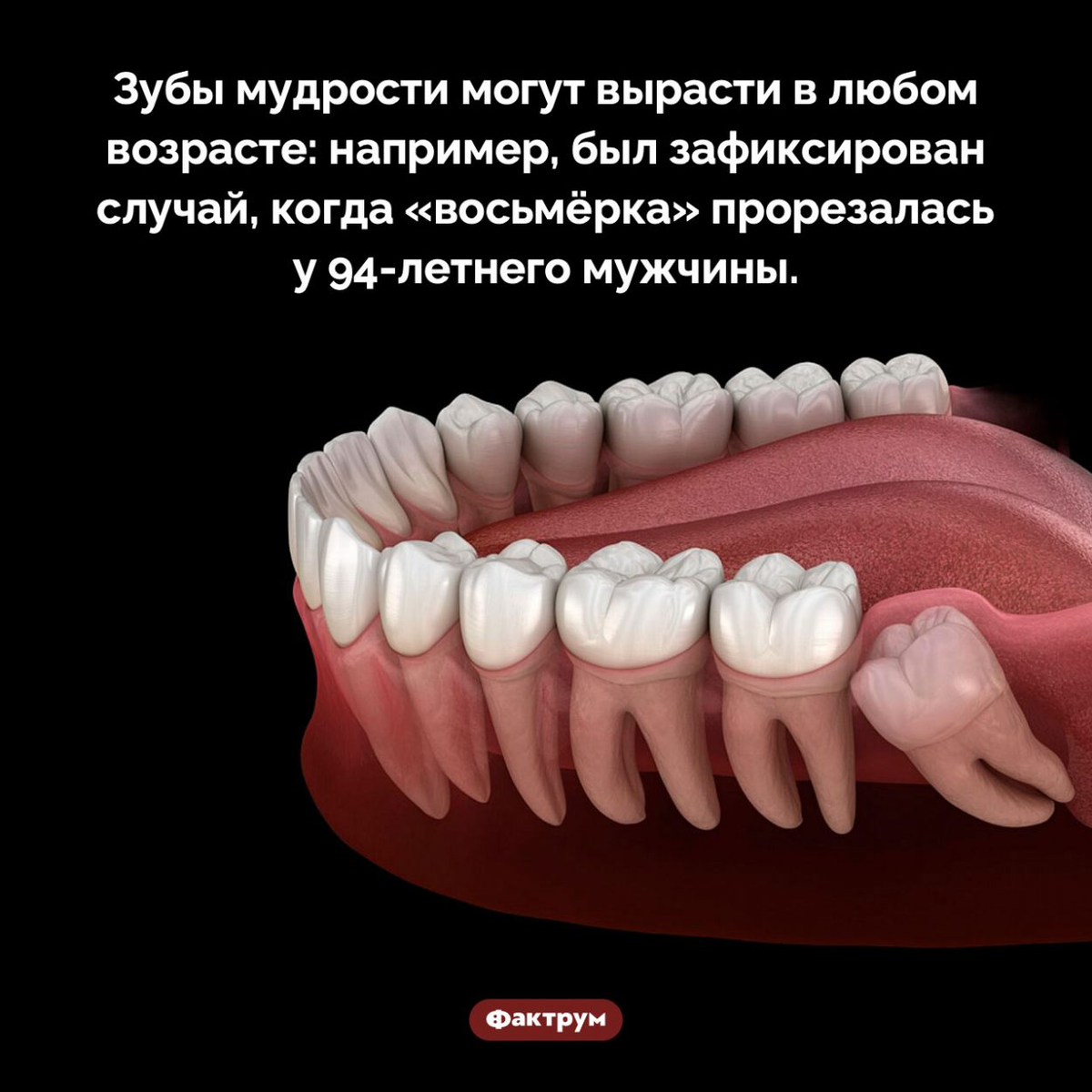 Как выглядит выросший зуб мудрости Annoying third molar Dental jokes, Wisdom teeth, Dental fun