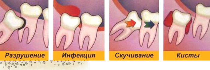 Удален зуб нижняя 7. Перикоронарит воспаление. Удалённый зуб мудрости.