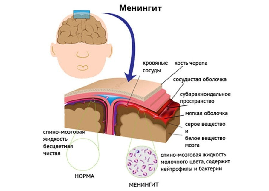 Менингит – симптомы, причины, признаки, диагностика и лечение в «СМ-Клиника»