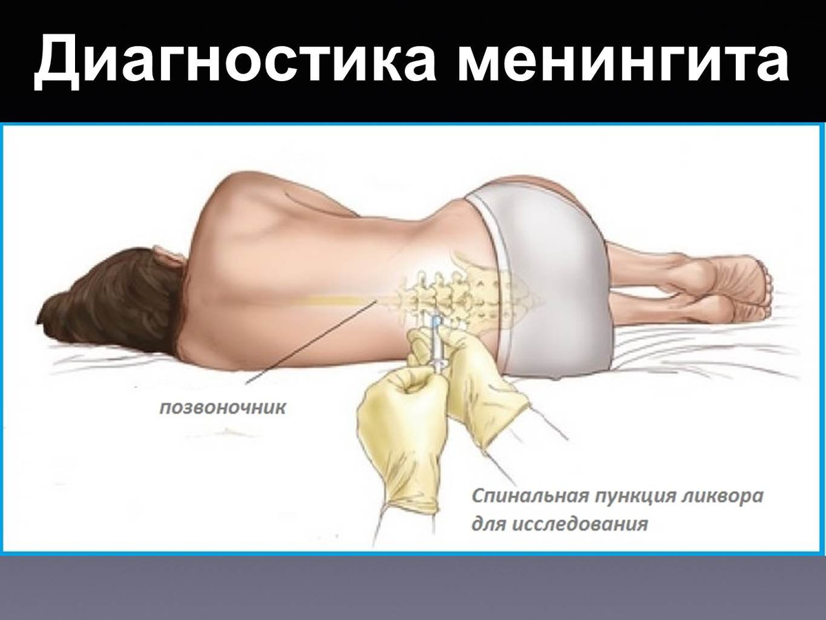 Люмбальная пункция менингит диагностика. Менингит люмбальная пункция у детей. Люмбальная пункция при менингите ликвор. Пункция для выявления менингита.